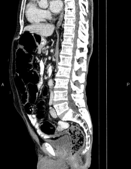 Ampullary adenocarcinoma (Radiopaedia 86093-102032 D 49).jpg