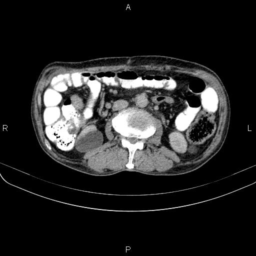 Ampullary adenocarcinoma (Radiopaedia 86093-102033 Axial C+ delayed 63).jpg