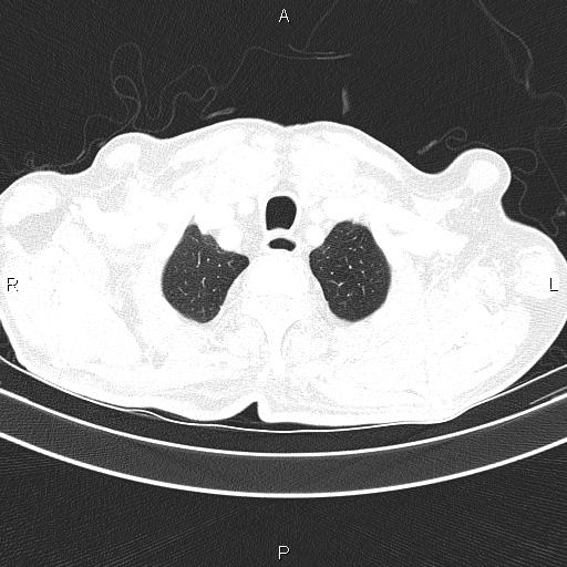 File:Ampullary adenocarcinoma (Radiopaedia 86093-102033 Axial lung window 15).jpg