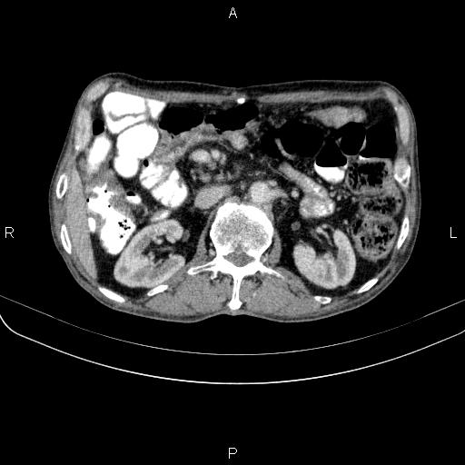 Ampullary adenocarcinoma (Radiopaedia 86093-102033 B 65).jpg