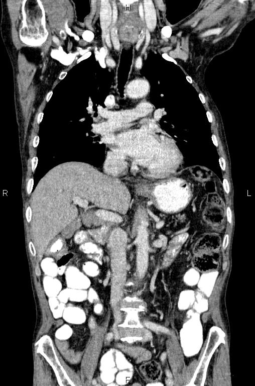 Ampullary adenocarcinoma (Radiopaedia 86093-102033 D 28).jpg