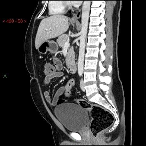Ampullary carcinoma (Radiopaedia 56396-63056 D 57).jpg