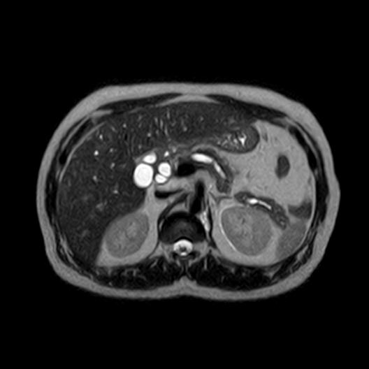 File:Ampullary tumor (Radiopaedia 27294-27479 T2 15).jpg