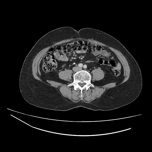 Ampullary tumor (Radiopaedia 60333-67998 A 52).jpg