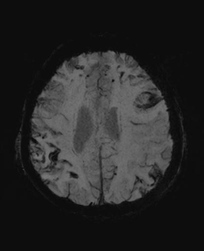 File:Amyloid angiopathy with inflammation (Radiopaedia 30360-31002 Axial SWI MIP 45).jpg