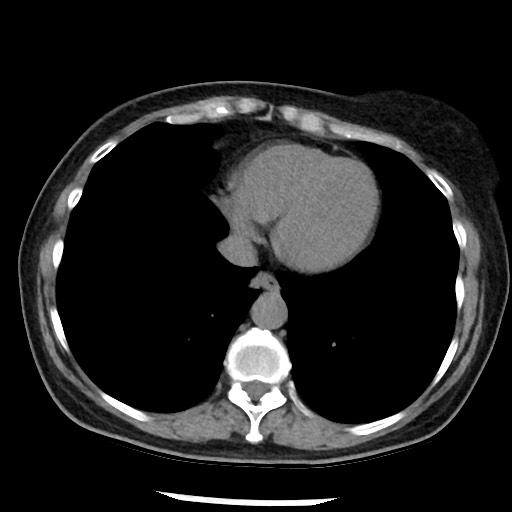 File:Amyloidosis - bronchial and diffuse nodular pulmonary involvement (Radiopaedia 60156-67744 Axial non-contrast 42).jpg