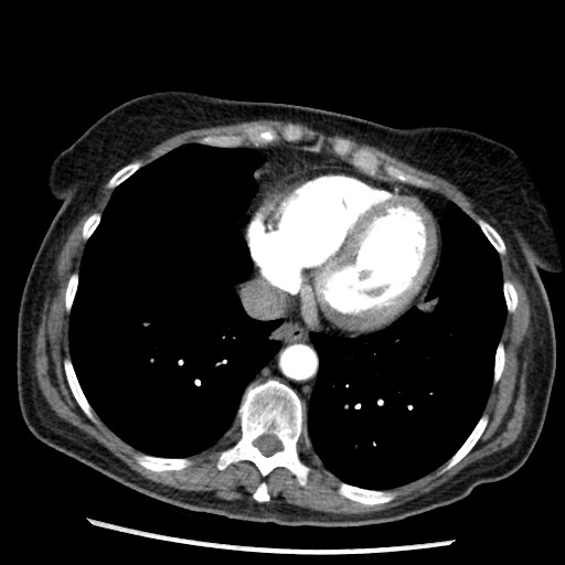 Amyloidosis - bronchial and diffuse nodular pulmonary involvement (Radiopaedia 60156-67745 A 39).jpg