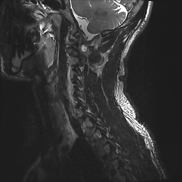 Amyotrophic lateral sclerosis (Radiopaedia 87352-103658 I 12).jpg