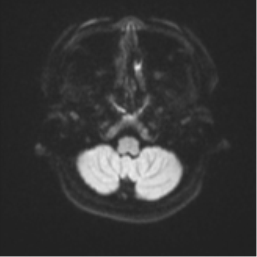Anaplastic astroblastoma (Radiopaedia 55666-62194 Axial DWI 33).png