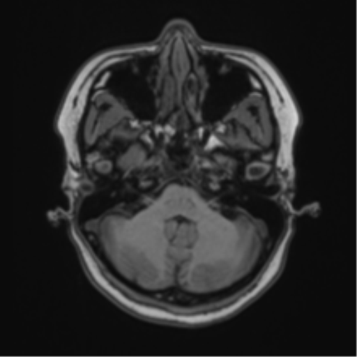 Anaplastic astroblastoma (Radiopaedia 55666-62194 Axial T1 17).png