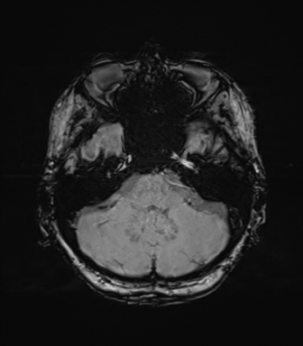 Anaplastic astrocytoma (Radiopaedia 86943-103160 Axial SWI 24).png