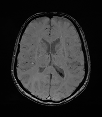 Anaplastic astrocytoma (Radiopaedia 86943-103160 Axial SWI 52).png