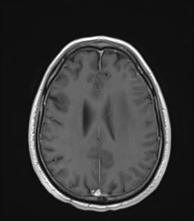 Anaplastic astrocytoma IDH wild-type (Radiopaedia 49984-55273 Axial T1 C+ 39).png