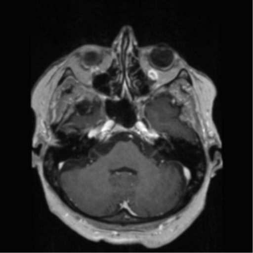 File:Anaplastic astrocytoma IDH wild-type (pseudoprogression) (Radiopaedia 42209-45278 Axial T1 C+ 46).png