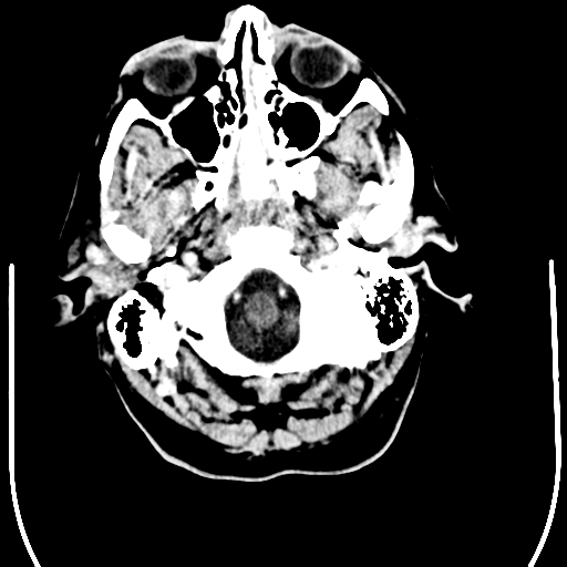 File:Anaplastic meningioma with recurrence (Radiopaedia 34452-35781 Axial Contrast 3).png