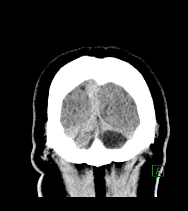 Anaplastic oligodendroglioma (Radiopaedia 79571-92753 Coronal non-contrast 65).jpg