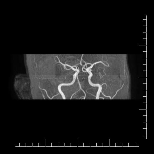 File:Aneurysm of posterior communicating artery (Radiopaedia 20188-20163 MRA 13).jpg