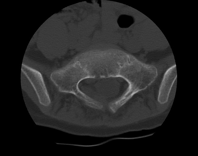 Aneurysmal bone cyst - sacrum (Radiopaedia 65190-74195 Axial bone window 17).jpg