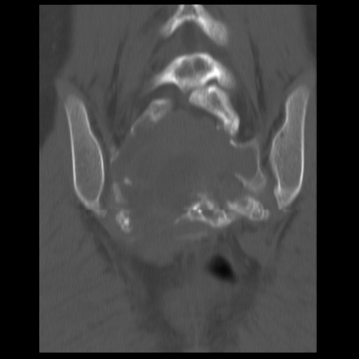 File:Aneurysmal bone cyst - sacrum (Radiopaedia 65190-74195 Coronal bone window 9).jpg