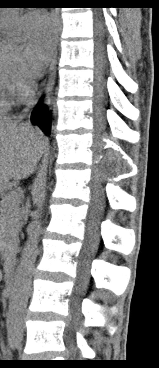 Aneurysmal bone cyst T11 (Radiopaedia 29294-29721 E 40).jpg
