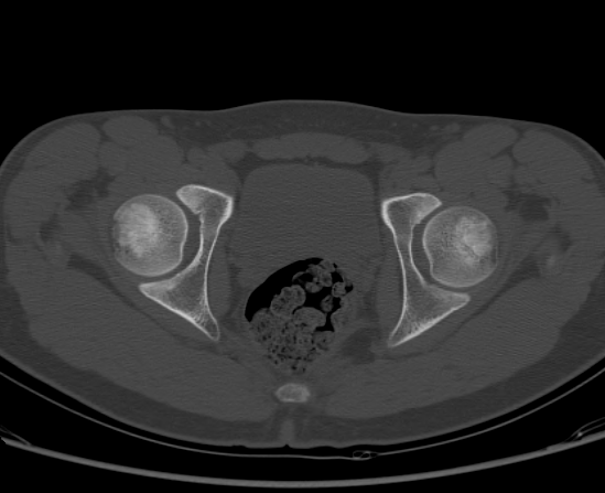 File:Aneurysmal bone cyst of ischium (Radiopaedia 25957-26094 Axial bone window 57).png