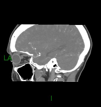 Aneurysmal subarachnoid hemorrhage with intra-axial extension (Radiopaedia 84371-99732 B 20).jpg