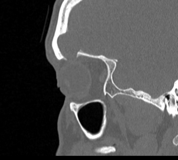 Angular epidermoid cyst (Radiopaedia 46908-51439 Sagittal bone window 76).png