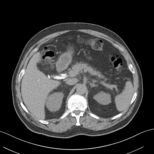 Annular pancreas (Radiopaedia 38292-40322 Coronal 1).png