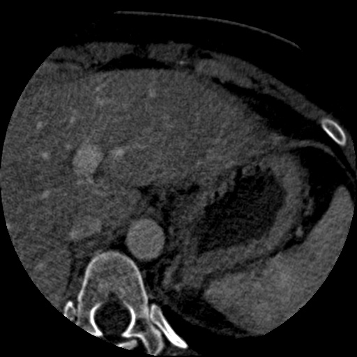 File:Anomalous left coronary artery from the pulmonary artery (ALCAPA) (Radiopaedia 40884-43586 A 93).jpg