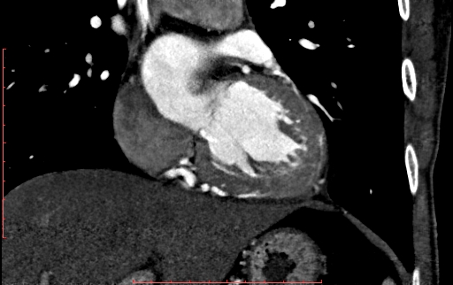 Anomalous left coronary artery from the pulmonary artery (ALCAPA) (Radiopaedia 70148-80181 B 158).jpg