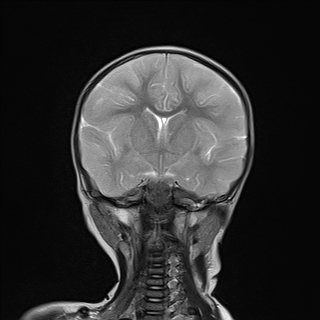 File:Anoxic brain injury (Radiopaedia 79165-92139 Coronal T2 13).jpg