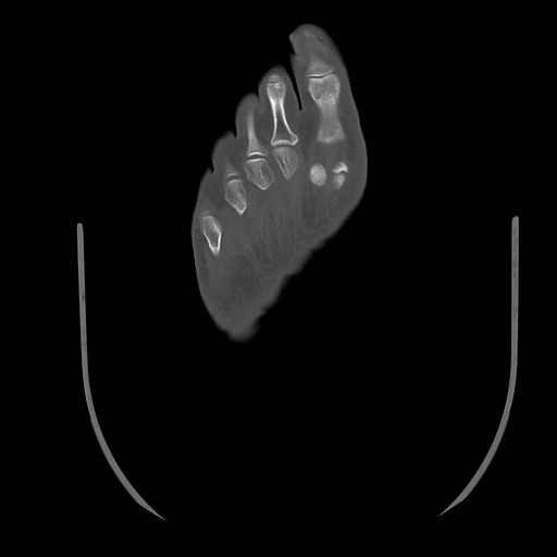 File:Anterior calcaneal process fracture (Radiopaedia 82590-96762 Axial bone window 43).jpg