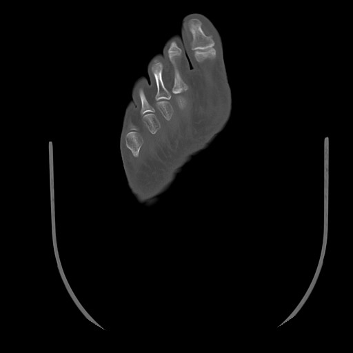 Anterior calcaneal process fracture (Radiopaedia 82590-96762 Axial bone window 44).jpg