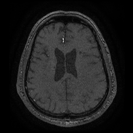 Anterior cerebral artery infarction (Radiopaedia 46794-51323 Axial MRA 151).jpg