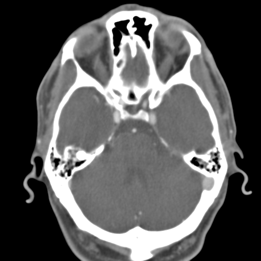 Anterior cerebral artery territory infarct (Radiopaedia 39327-41581 B 40).png