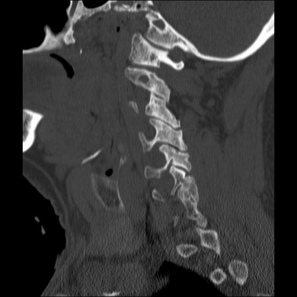 Anterior cervical postdiscectomy arthrodesis (Radiopaedia 32678-33646 Sagittal bone window 19).jpg