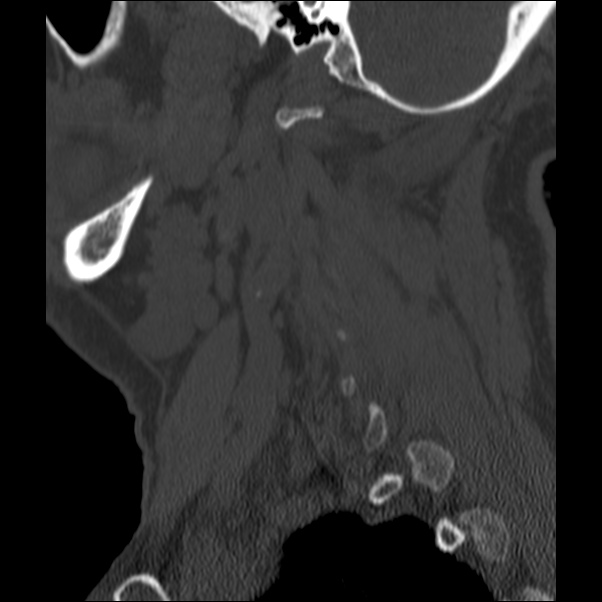 Anterior cervical postdiscectomy arthrodesis (Radiopaedia 32678-33646 Sagittal bone window 68).jpg