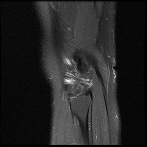 File:Anterior cruciate ligament avulsion fracture (Radiopaedia 58939-66193 Sagittal PD fat sat 3).jpg
