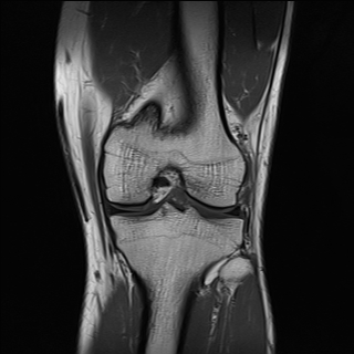 File:Anterior cruciate ligament full thickness tear (Radiopaedia 66268-75467 Coronal T1 12).jpg
