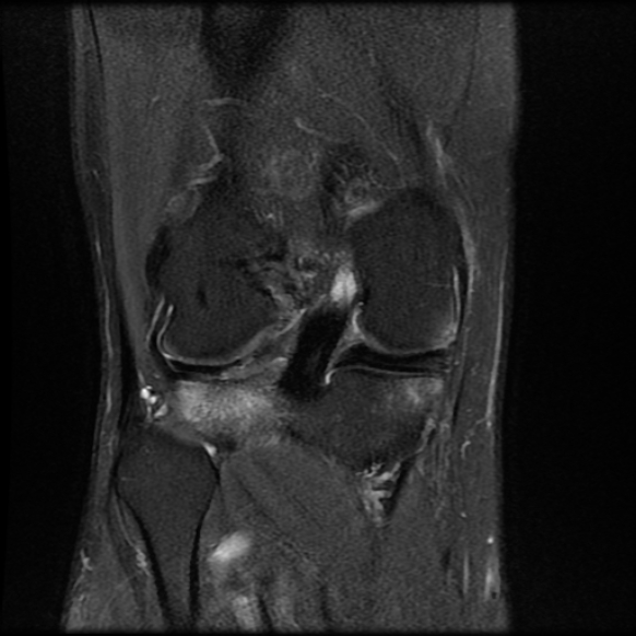 File:Anterior cruciate ligament graft tear and bucket-handle tear of medial meniscus (Radiopaedia 75867-87254 Coronal PD fat sat 17).jpg