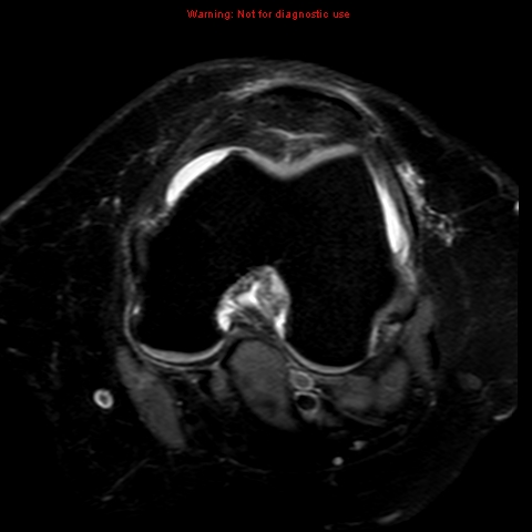 File:Anterior cruciate ligament tear (Radiopaedia 12329-12612 Axial T2 fat sat 13).jpg
