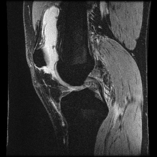 Anterior cruciate ligament tear (Radiopaedia 61500-69462 F 37).jpg