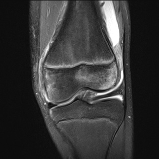 File:Anterior cruciate ligament tear - pediatric (Radiopaedia 62152-70260 Coronal PD fat sat 16).jpg