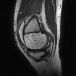 File:Anterior cruciate ligament tear - pediatric (Radiopaedia 62152-70260 Sagittal PD 41).jpg