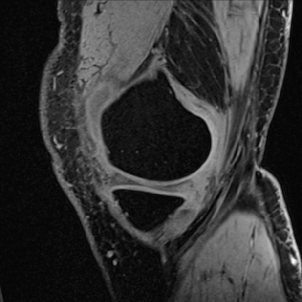 Anterior cruciate ligament tear - ramp lesion (Radiopaedia 71883-82322 Sagittal T1 vibe 112).jpg