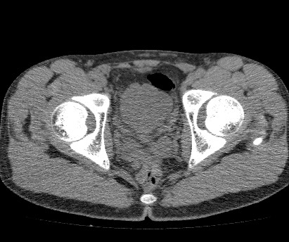 File:Anterior inferior iliac spine avulsion fracture (Radiopaedia 81312-94999 Axial non-contrast 54).jpg