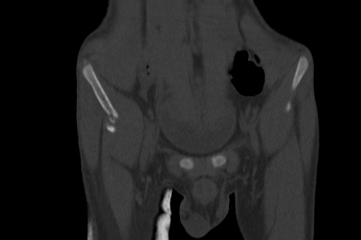 Anterior inferior iliac spine avulsion injury (Radiopaedia 88666-105376 Coronal bone window 15).jpg