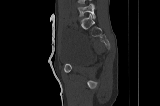 Anterior inferior iliac spine avulsion injury (Radiopaedia 88666-105376 Sagittal bone window 41).jpg