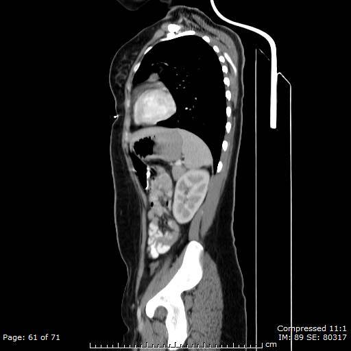 File:Anterior mediastinal B cell Lymphoma (Radiopaedia 50677-56114 C 31).jpg