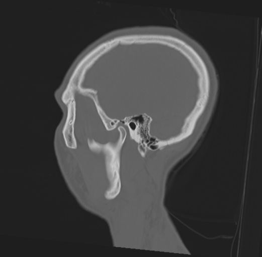 Anterior nasal spine fracture (Radiopaedia 46138-50494 Sagittal bone window 13).png